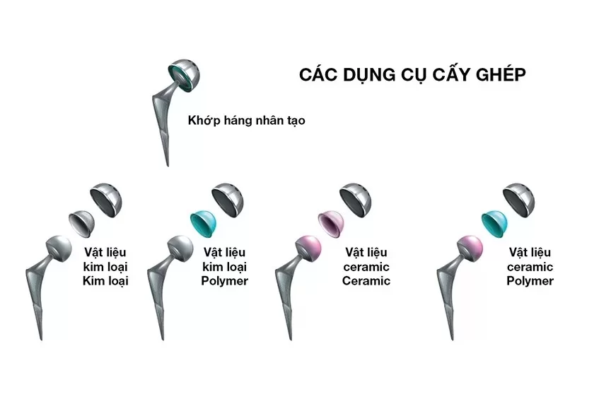 Thay khớp háng nhân tạo 7 thay khop hang nhan tao benh vien dai hoc nam can tho 1