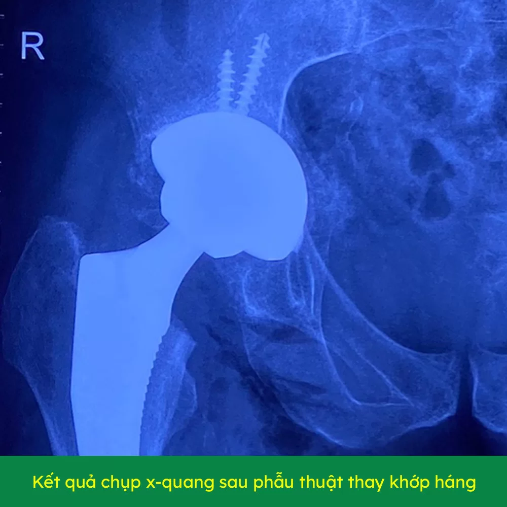 Bệnh viện Đại học Nam Cần Thơ kết hợp cùng bác sĩ chuyên gia chấn thương chỉnh hình Bệnh viện Trung ương Huế phẫu thuật thay khớp háng, giúp bệnh nhân chấm dứt cơn đau do hoại tử chỏm xương đùi.
