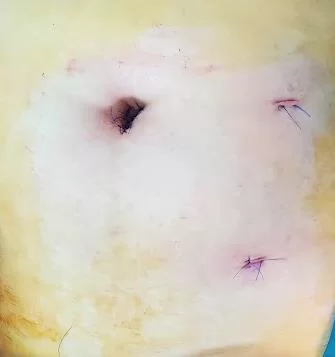 U BUỒNG TRỨNG CÓ NÊN CẮT BỎ KHI PHẪU THUẬT? MỔ NỘI SOI HAY MỔ MỞ? THẾ NÀO LÀ NANG CẠNH BUỒNG TRỨNG – VÒI TRỨNG? 6 6 1