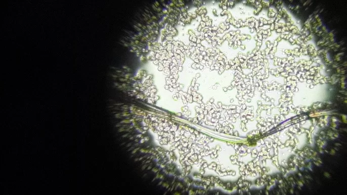 BỆNH CHÂN VOI DO GIUN CHỈ – CĂN BỆNH NGUY HIỂM 6 6 13