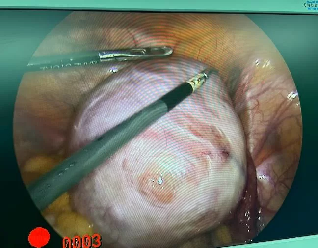 U BUỒNG TRỨNG CÓ NÊN CẮT BỎ KHI PHẪU THUẬT? MỔ NỘI SOI HAY MỔ MỞ? THẾ NÀO LÀ NANG CẠNH BUỒNG TRỨNG – VÒI TRỨNG? 7 7 1