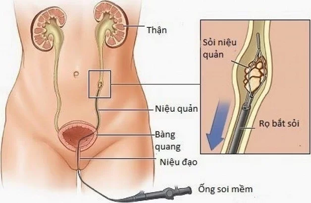 Tán sỏi ngược dòng - Bệnh viện đại học Nam Cần Thơ
