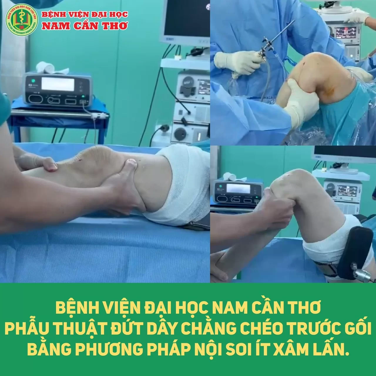 PHẪU THUẬT NỘI SOI TÁI TẠO LẠI DÂY CHẰNG CHÉO TRƯỚC CHO BỆNH NHÂN NỮ 28 TUỔI GIÚP BỆNH NHÂN PHỤC HỒI LẠI ĐỘ VỮNG CỦA KHỚP GỐI TẠI Bệnh viện Đại học Nam Cần Thơ.