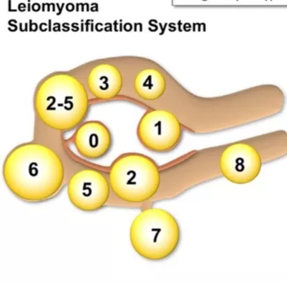 PHÂN LOẠI FIGO VỀ U XƠ TỬ CUNG