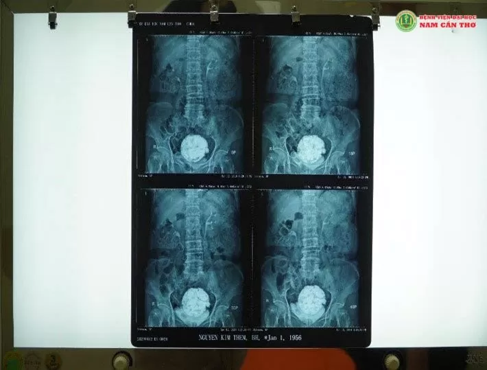 Ảnh chụp MRI bệnh nhân có khối u kích thước lớn bị vôi hóa và sau khi bóc tách