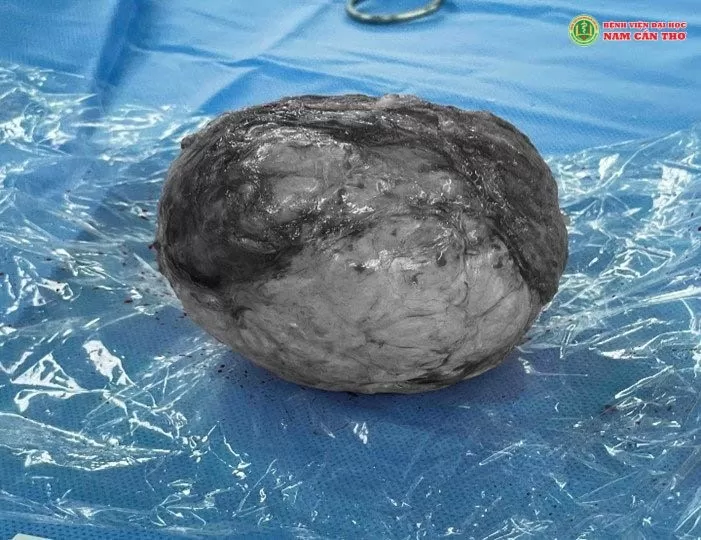 Ảnh chụp MRI bệnh nhân có khối u kích thước lớn bị vôi hóa và sau khi bóc tách