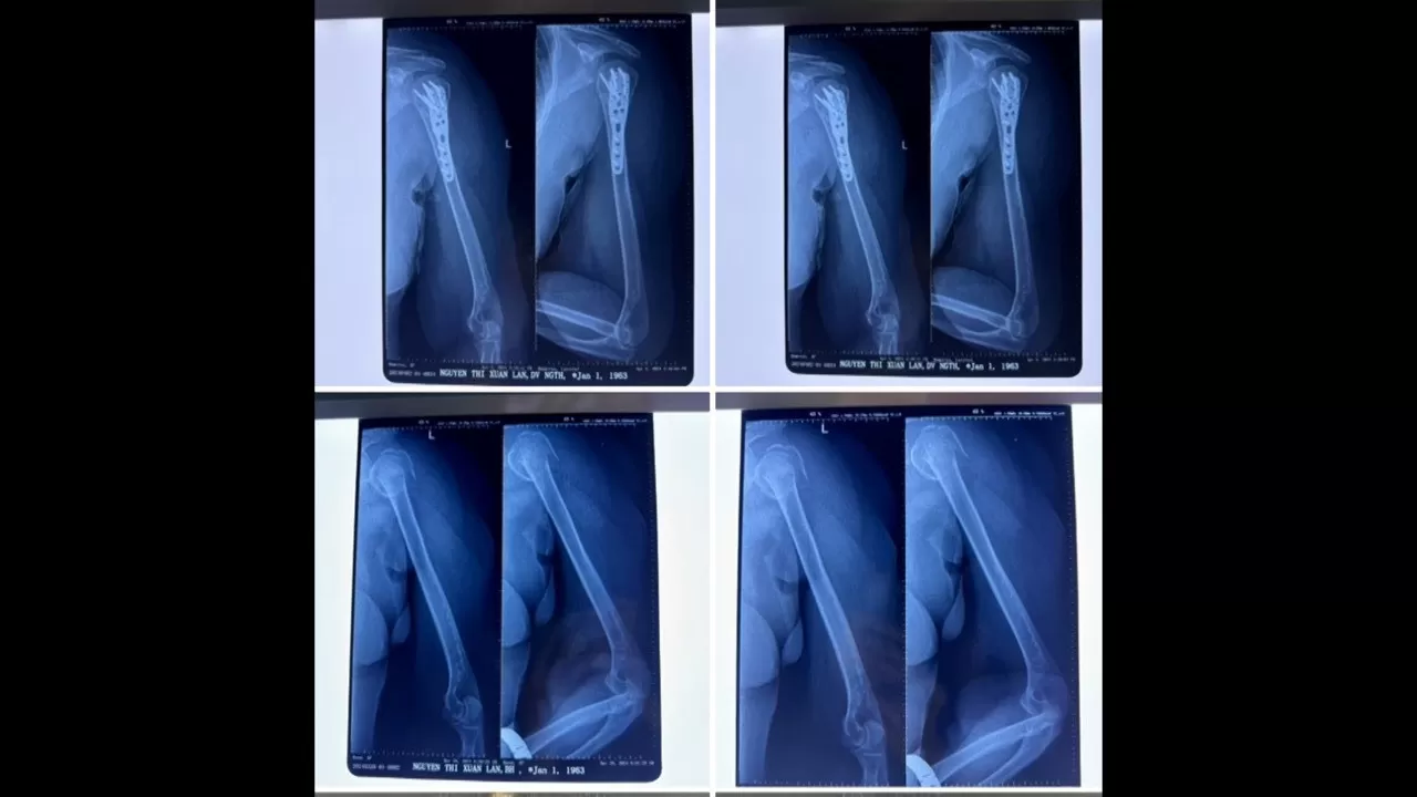 Phẫu thuật thành công ca kết hợp xương phức tạp cho cụ bà 61 tuổi ở Cần Thơ