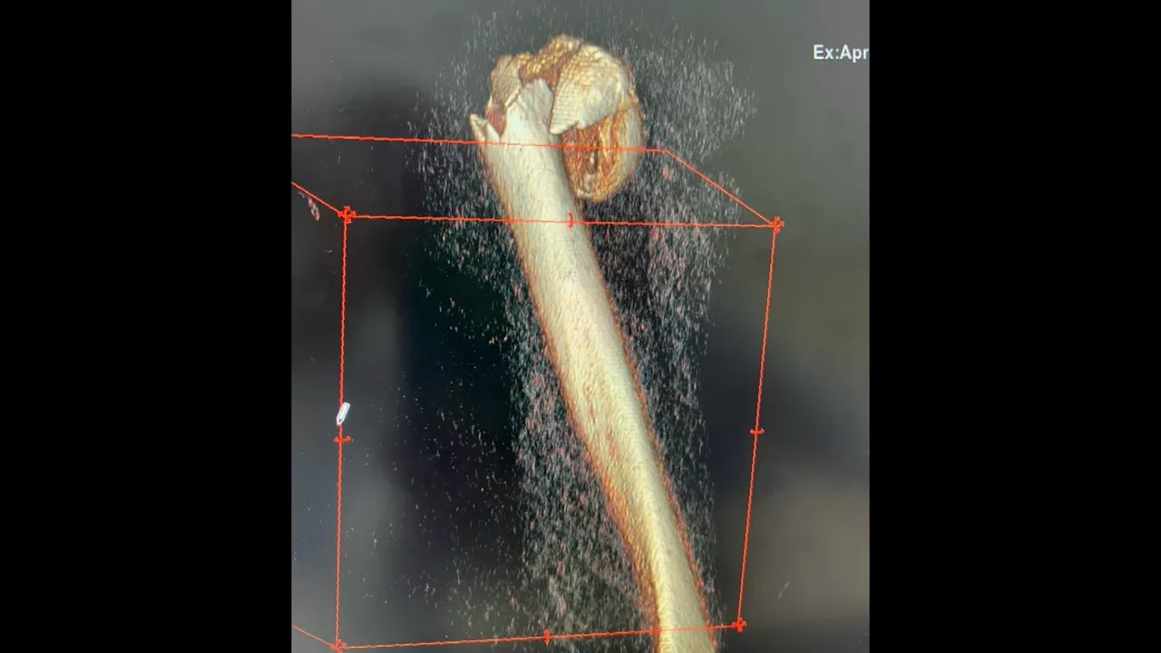 Phẫu thuật thành công ca kết hợp xương phức tạp cho cụ bà 61 tuổi ở Cần Thơ