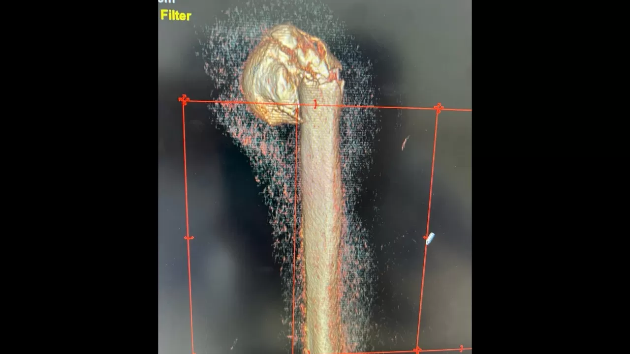 Phẫu thuật thành công ca kết hợp xương phức tạp