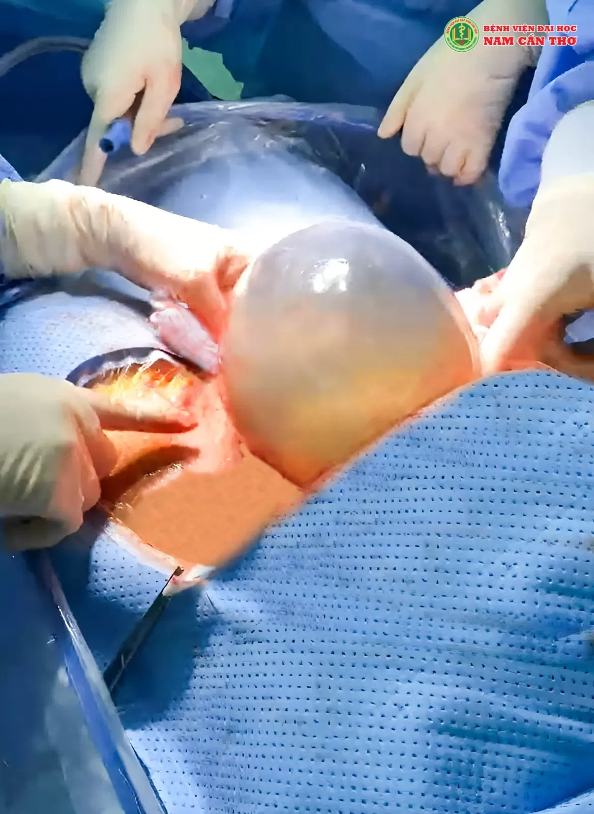 CHÀO ĐÓN THIÊN THẦN NHỎ “ BỌC ĐIỀU” CHÀO ĐỜI TẠI BỆNH VIỆN ĐẠI HỌC NAM CẦN THƠ