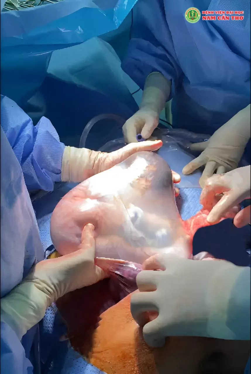 CHÀO ĐÓN THIÊN THẦN NHỎ “ BỌC ĐIỀU” CHÀO ĐỜI TẠI BỆNH VIỆN ĐẠI HỌC NAM CẦN THƠ