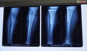 PHẪU THUẬT KẾT HỢP XƯƠNG TRÊN MÀN HÌNH TĂNG SÁNG THÀNH CÔNG CA GÃY PHỨC TẠP XƯƠNG CẲNG CHÂN 1 PHẪU THUẬT KẾT HỢP XƯƠNG TRÊN MÀN HÌNH TĂNG SÁNG THÀNH CÔNG CA GÃY PHỨC TẠP XƯƠNG CẲNG CHÂN