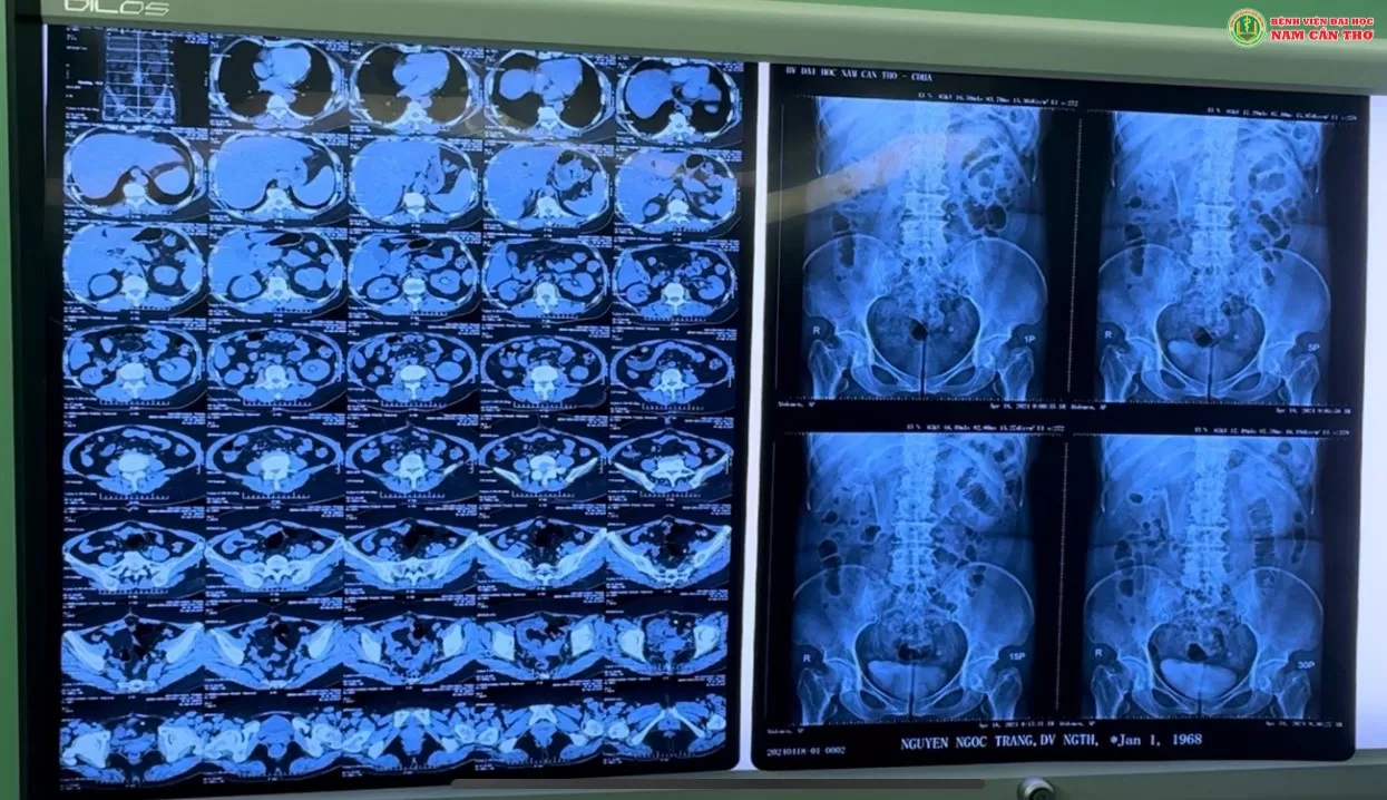 Ảnh chụp cắt lớp vi tính của bệnh nhân T