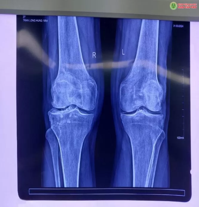 NỘI SOI KHỚP GỐI LẤY SỎI