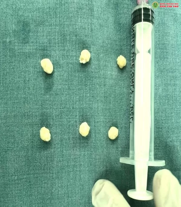 NỘI SOI KHỚP GỐI LẤY SỎI