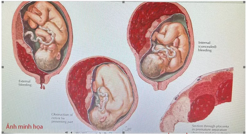 CẤP CỨU BẢO TỒN THÀNH CÔNG KHẢ NĂNG SINH SẢN CHO TRƯỜNG HỢP NHAU BONG NON THỂ NẶNG
