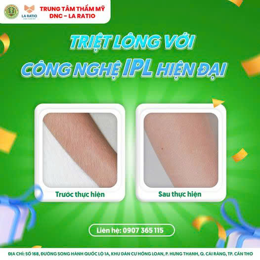 TRIỆT LÔNG VĨNH VIỄN – AN TOÀN – KHÔNG XÂM LẤN TẠI DNC – LARATIO