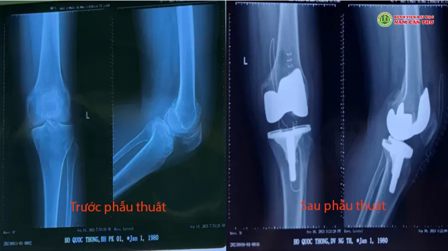 PHẪU THUẬT THAY KHỚP GỐI BÁN PHẦN – BƯỚC TIỀN VƯỢT BẬT CHO CUỘC SỐNG KHÔNG ĐAU 1 PHẪU THUẬT THAY KHỚP GỐI THÀNH CÔNG TẠI BỆNH VIỆN ĐẠI HỌC NAM CẦN THƠ – BƯỚC TIỀN VƯỢT BẬC CHO CUỘC SỐNG KHÔNG ĐAU