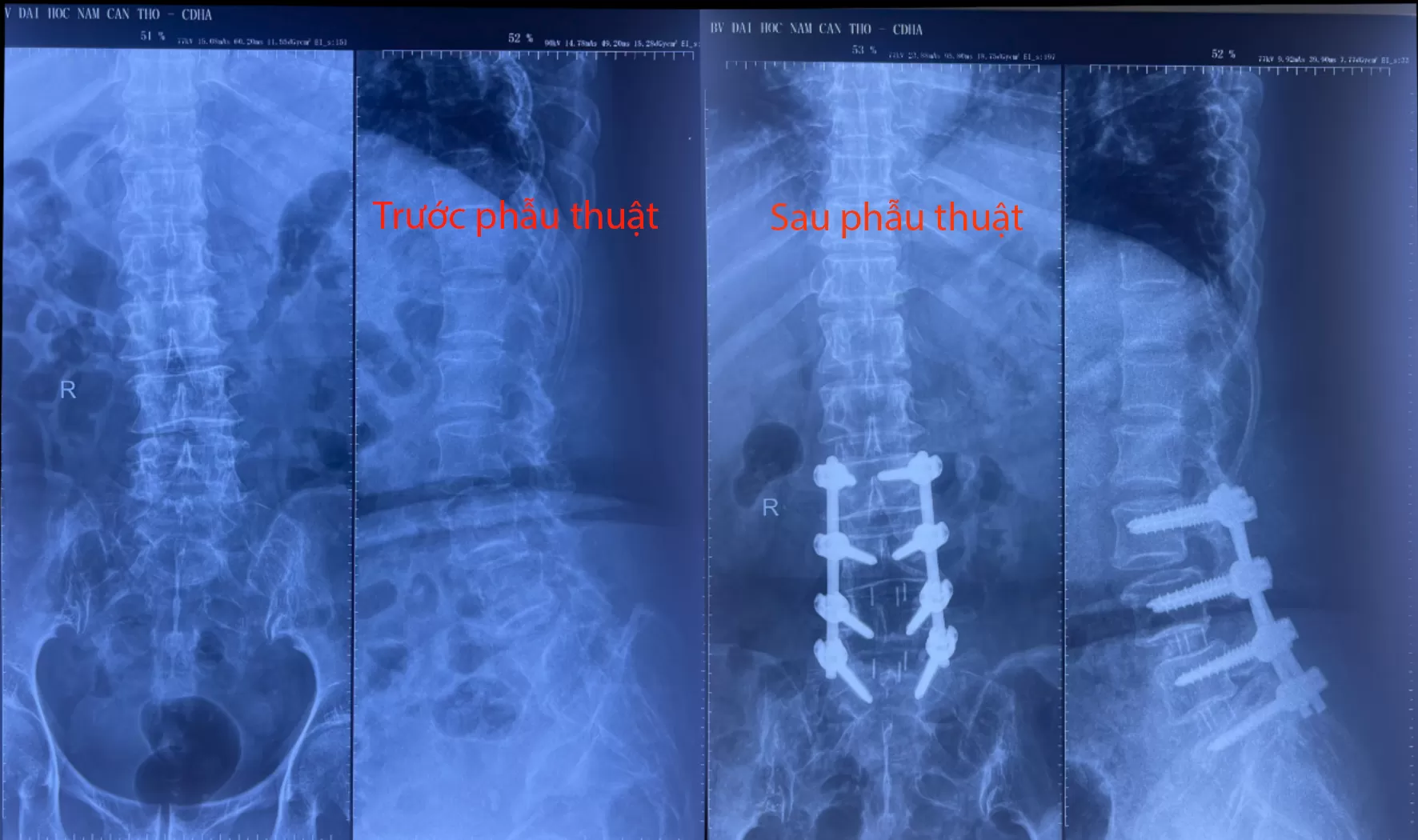 ĐIỀU TRỊ THÀNH CÔNG CA TRƯỢT ĐỐT SỐNG ĐA TẦNG