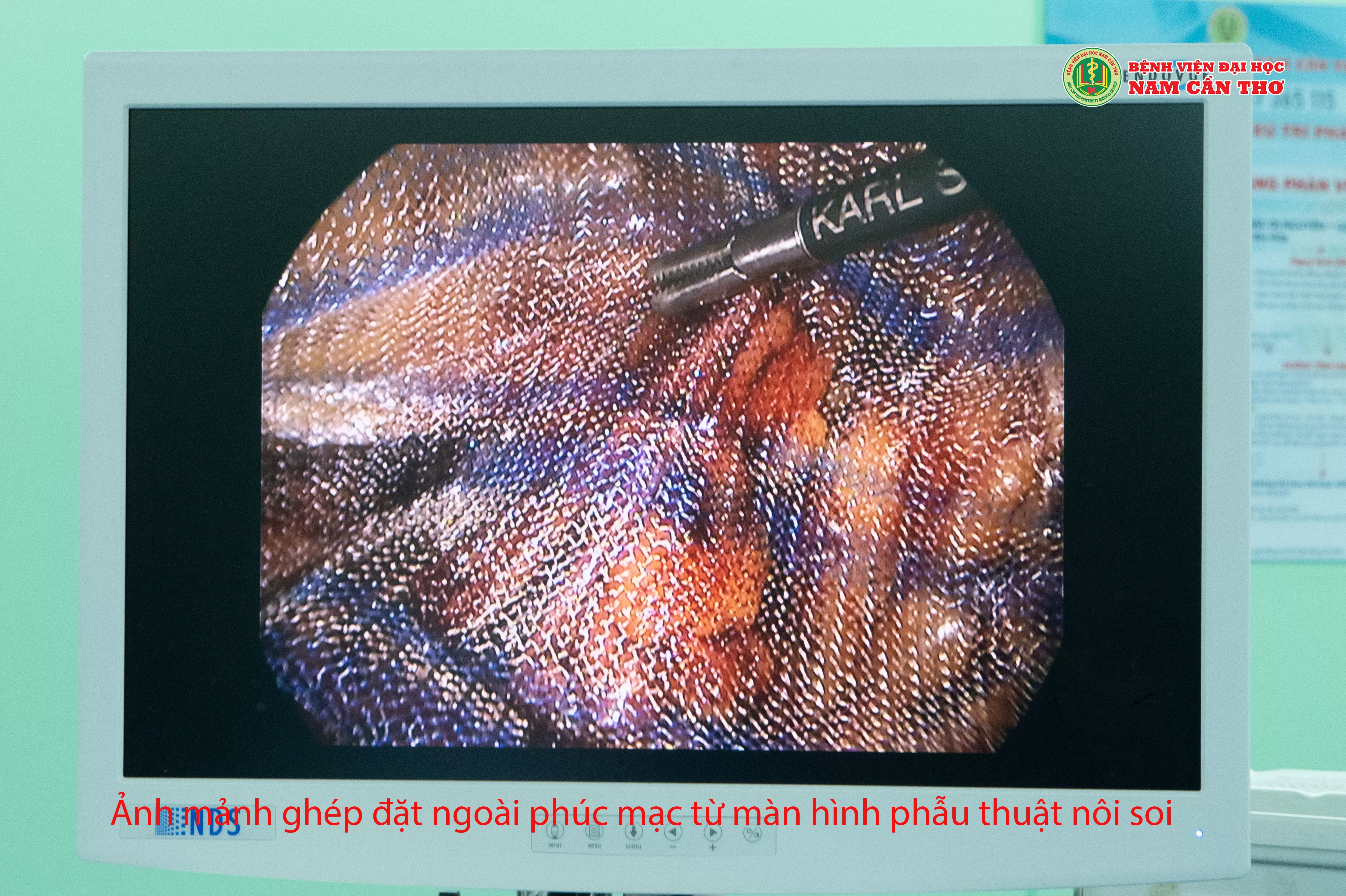 PHẪU THUẬT NỘI SOI ĐẶT MẢNH GHÉP NHÂN TẠO CHO BỆNH NHÂN BỊ THOÁT VỊ BẸN