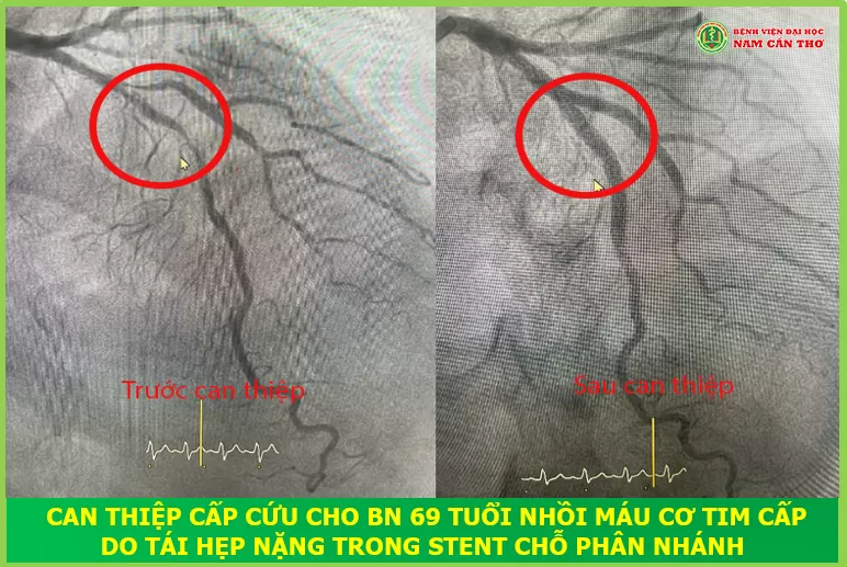 CAN THIỆP MẠCH VÀNH CẤP CỨU THÀNH CÔNG CHO BỆNH NHÂN 69 TUỔI NHỒI MÁU CƠ TIM CẤP DO TÁI HẸP NẶNG TRONG STENT PHÂN NHÁNH