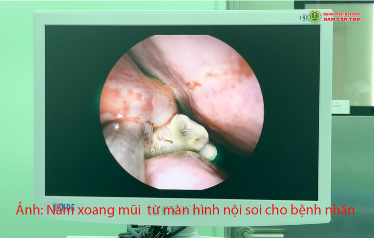 VIÊM XOANG MŨI DO NẤM- KHÔNG NÊN CHỦ QUAN