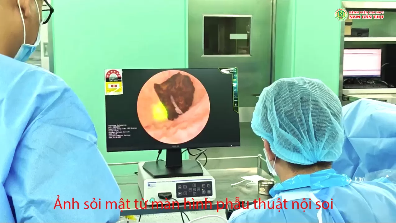 PHẪU THUẬT NỘI SOI ỐNG MỀM TÁN SỎI MẬT BẰNG LASER QUA ĐƯỜNG HẦM KEHR