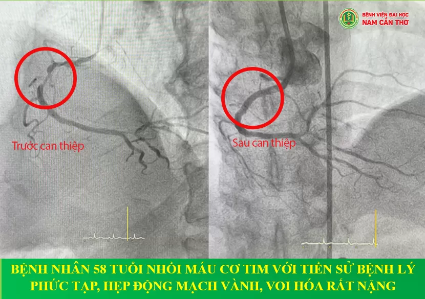 CAN THIỆP CHO BỆNH NHÂN 58 TUỔI NHỒI MÁU CƠ TIM VỚI TIỀN SỬ BỆNH LÝ PHỨC TẠP, HẸP ĐỘNG MẠCH VÀNH, VOI HÓA RẤT NẶNG