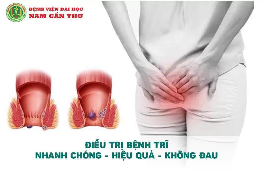 ĐIỀU TRỊ BỆNH TRĨ: NHANH CHÓNG - HIỆU QUẢ - KHÔNG ĐAU🟢