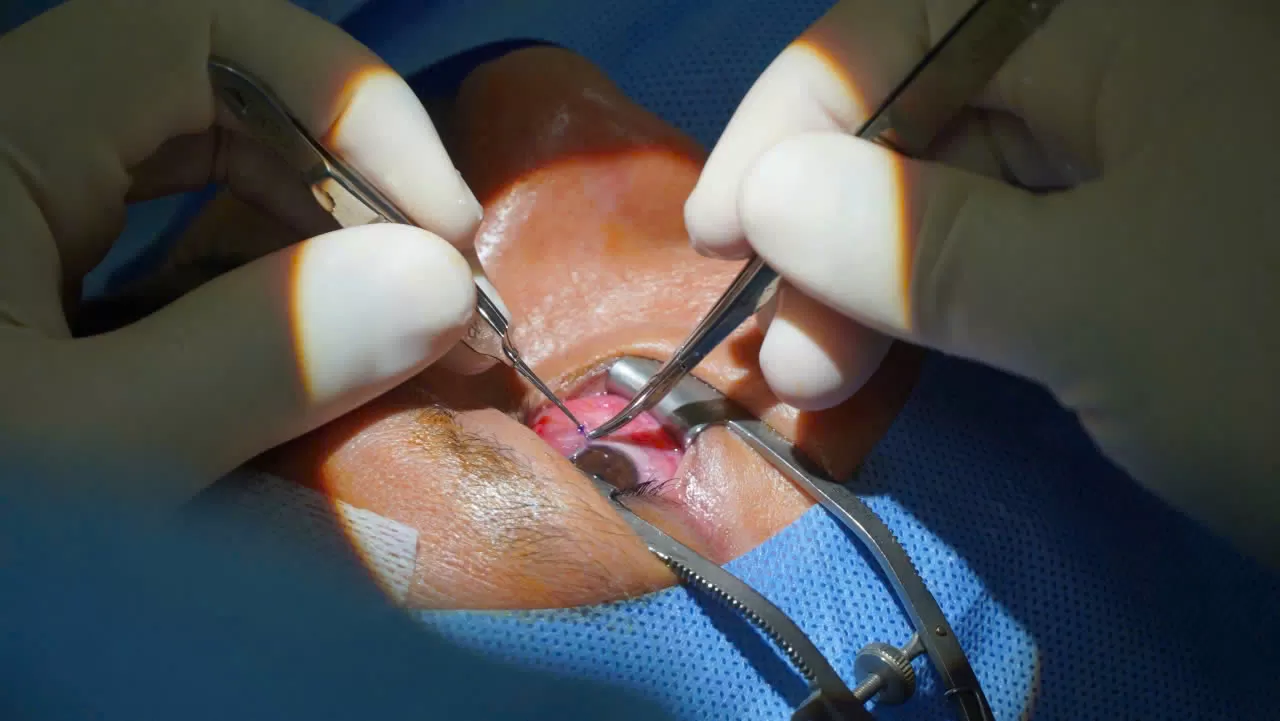 KHÁM SỨC KHỎE THIỆN NGUYỆN – KHÁCH HÀNG BẤT NGỜ ĐƯỢC BÁC SĨ HÀN QUỐC PHẪU THUẬT KÉO MÂY Ở MẮT