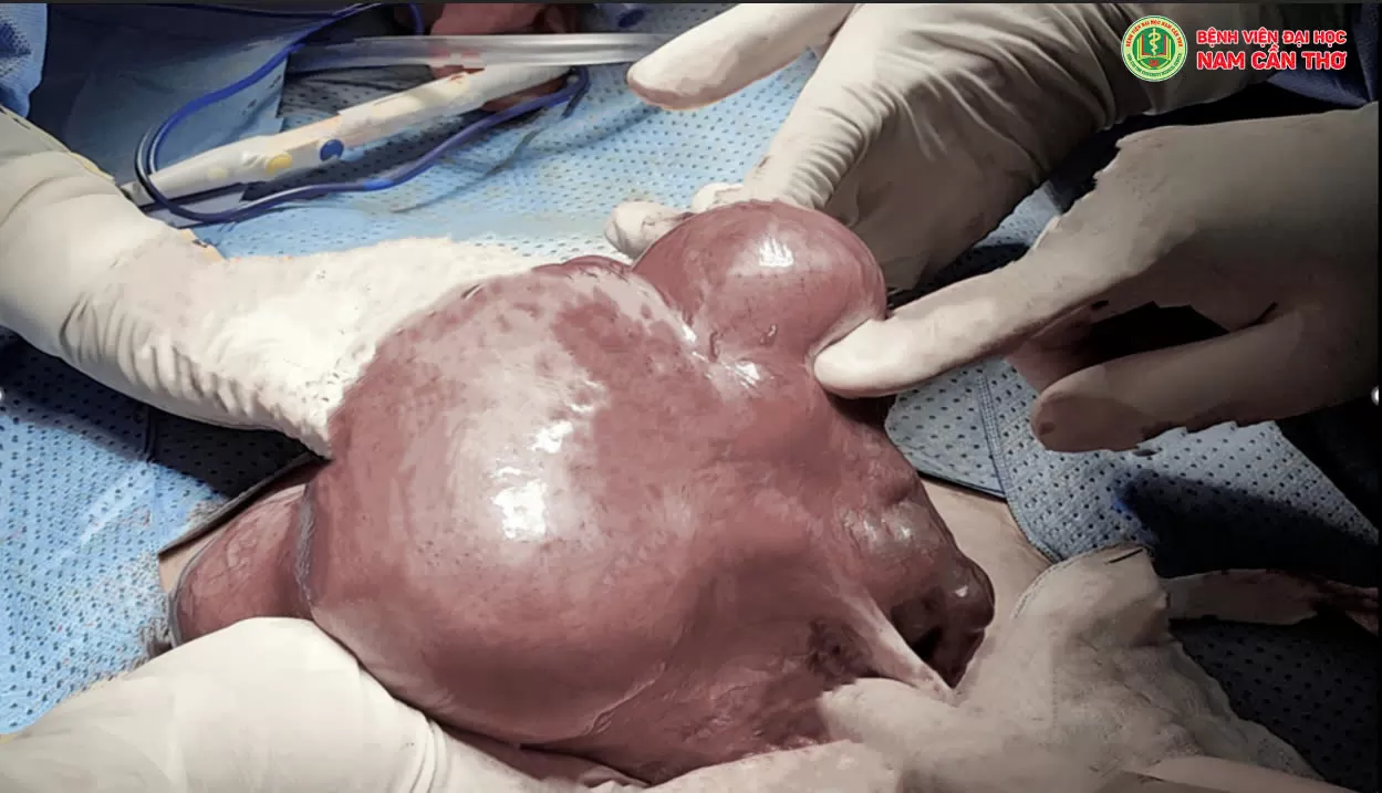 CẦN KHÁM PHỤ KHOA ĐỊNH KỲ - NHẰM PHÁT HIỆN SỚM KHỐI U PHỤ KHOA TRÁNH BIẾN CHỨNG NGUY HIỂM