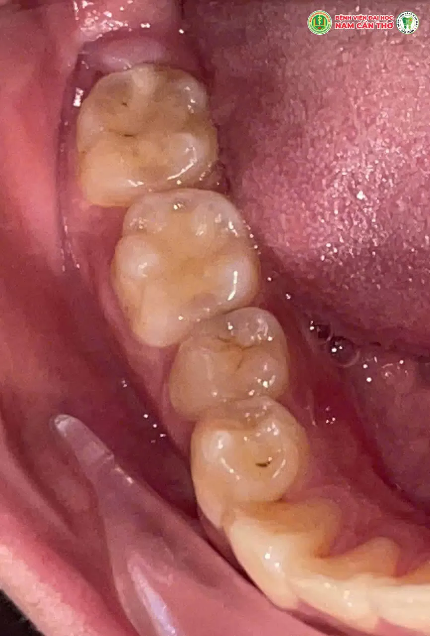 NHỔ RĂNG KHÔN AN TOÀN, HIỆU QUẢ TẠI TRUNG TÂM NHA KHOA BỆNH VIỆN ĐẠI HỌC NAM CẦN THƠ – RĂNG HÀM MẶT SÀI GÒN