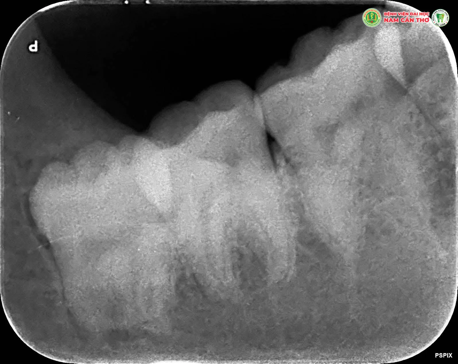 NHỔ RĂNG KHÔN AN TOÀN, HIỆU QUẢ TẠI TRUNG TÂM NHA KHOA BỆNH VIỆN ĐẠI HỌC NAM CẦN THƠ – RĂNG HÀM MẶT SÀI GÒN
