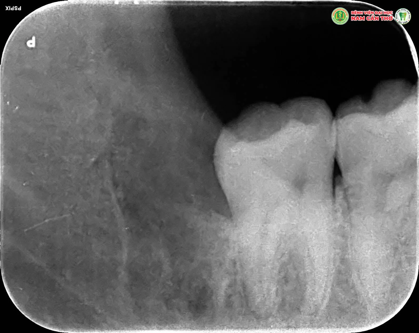 NHỔ RĂNG KHÔN AN TOÀN, HIỆU QUẢ TẠI TRUNG TÂM NHA KHOA BỆNH VIỆN ĐẠI HỌC NAM CẦN THƠ – RĂNG HÀM MẶT SÀI GÒN