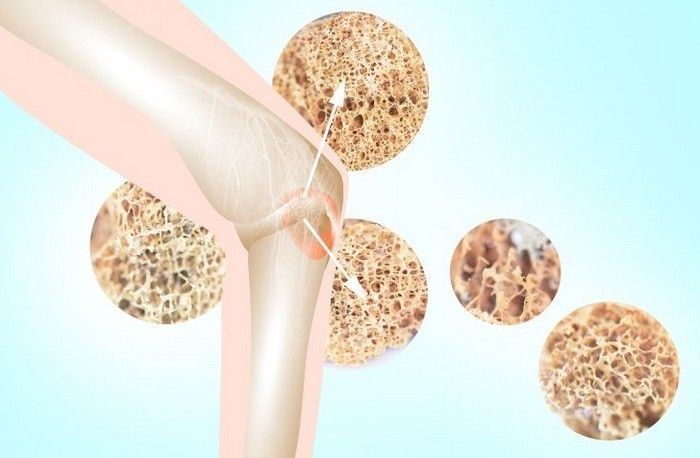 Minh họa cấu trúc xương trong bệnh loãng xương (internet)