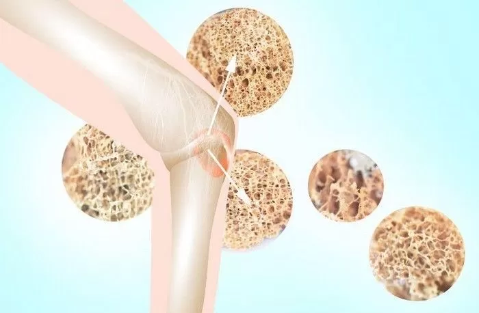Minh họa cấu trúc xương trong bệnh loãng xương (internet)