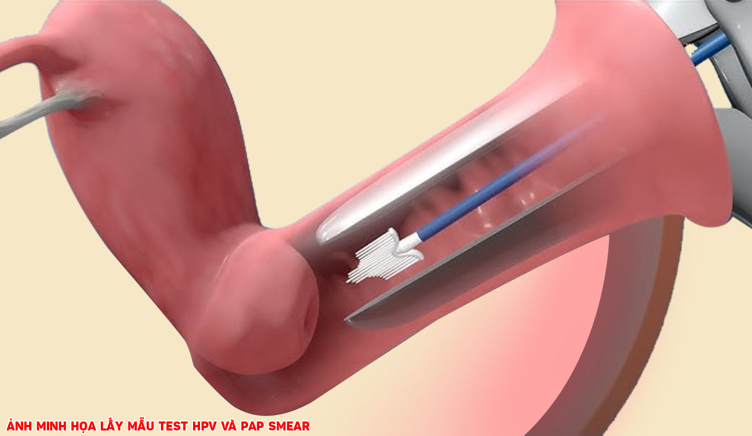 NGỪA UNG THƯ CỔ TỬ CUNG: XÉT NGHIỆM HPV VÀ PAP SMEAR KHÁC NHAU NHƯ THẾ NÀO?