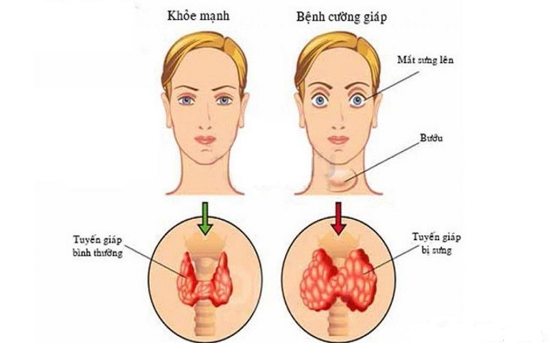 BỆNH CƯỜNG GIÁP Ở NGƯỜI TRẺ: BÁO ĐỘNG TỪ LỐI SỐNG HIỆN ĐẠI