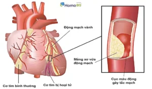 KHI TUỔI TIM QUAN TRỌNG HƠN TUỔI THẬT: VAI TRÒ CỦA TẦM SOÁT YẾU TỐ NGUY CƠ TIM MẠCH 2 1 1 1